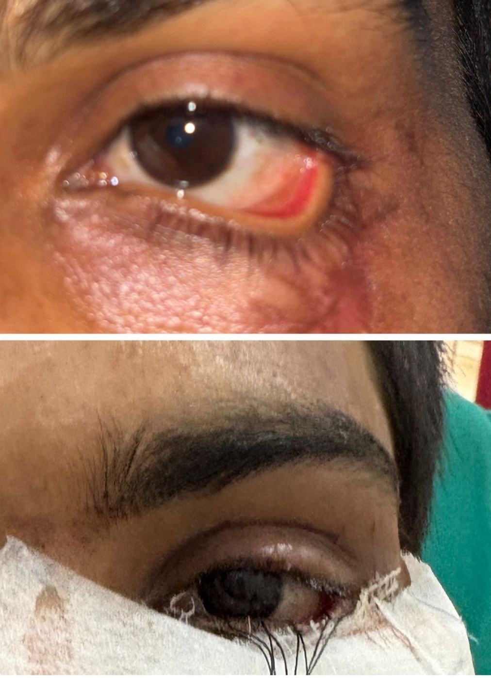 स्किन ग्राफ्टिंग से मरीज के पलक का सफल पुनर्निर्माण,,,,,