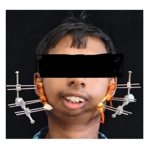 सिम्स में 24 वर्षीय युवक के बचपन से बंद जबड़े का सफल ऑपरेशन* *जटिल सर्जरी से खुला मुंह, आयुष्मान योजना से मिला निःशुल्क उपचार